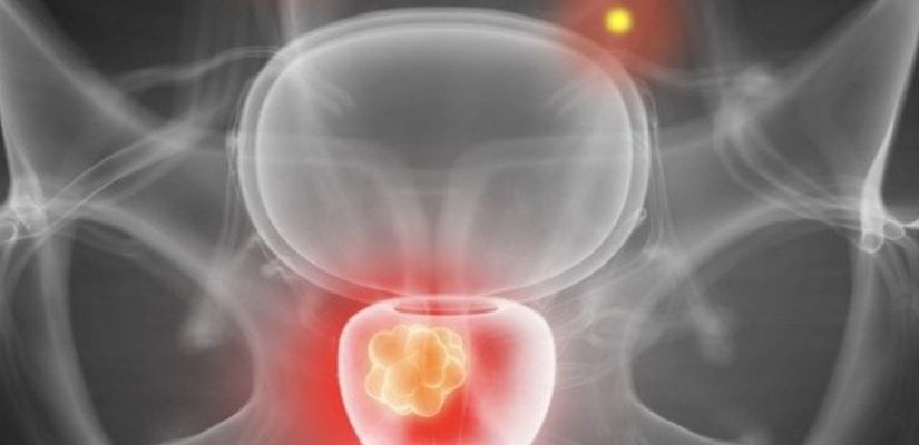 cancer-prostata-abiraterona-sobrevida