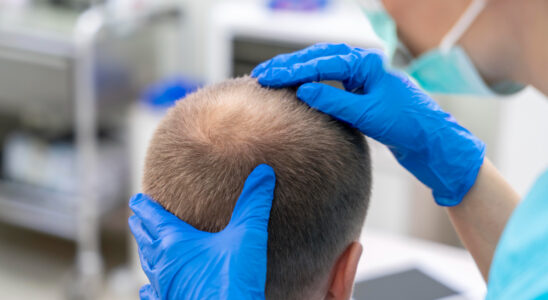 alopecia-calvicie-baricitinibe-olumiant