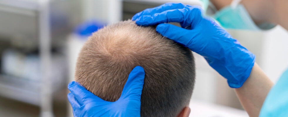 alopecia-calvicie-baricitinibe-olumiant