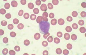 leucemia-linfoide-aguda-blincyto-Blinatumomabe