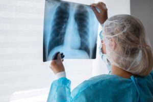 médica-analisando-raio-x-pulmão-tratamento-timb-gefitinibe